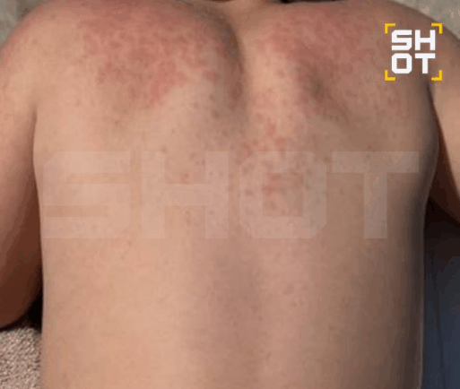 вирус Коксаки