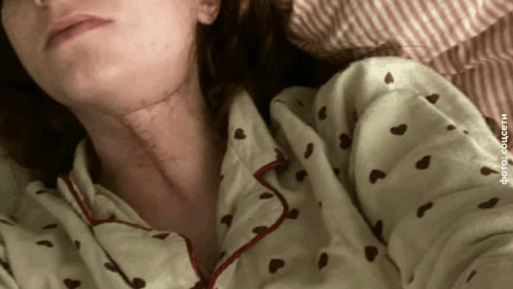 удаление зуба мудрости