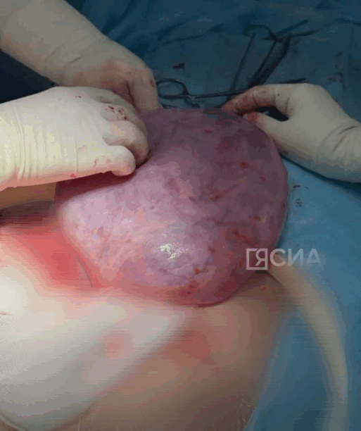 гигантская киста