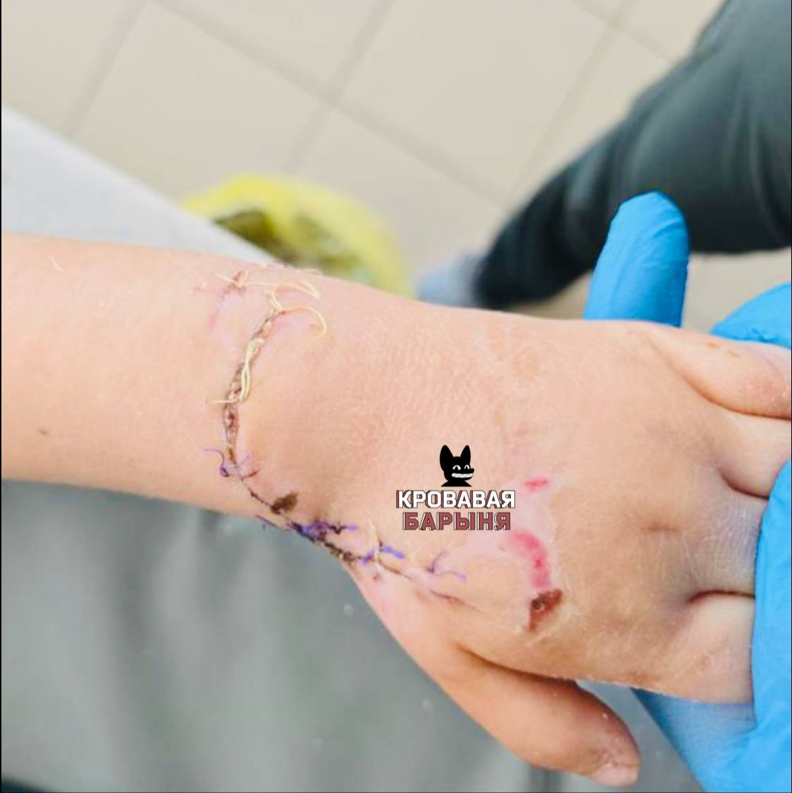 Экстренная помощь: спасение девочки после трагедии на эскалаторе